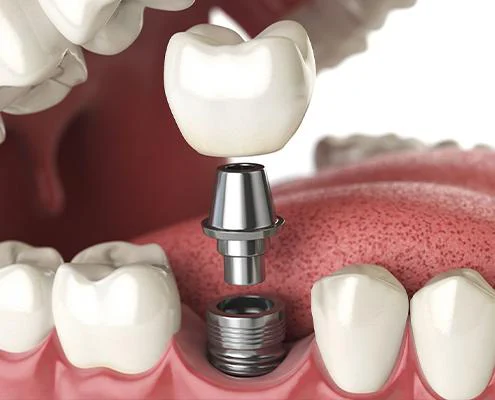 Dental Implants of Morris County Picture 1