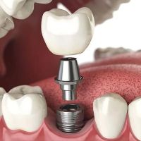 Dental Implants of Morris County ico