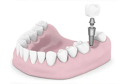 Dental Implants of Morris County Picture 10