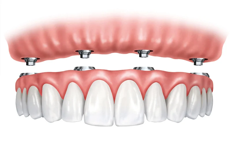 Dental Implants of Morris County Picture 8