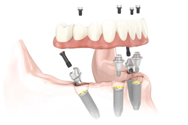Dental Implants of Morris County Picture 9