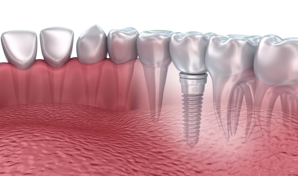 Hudson Valley Periodontics & Implantology Picture 7