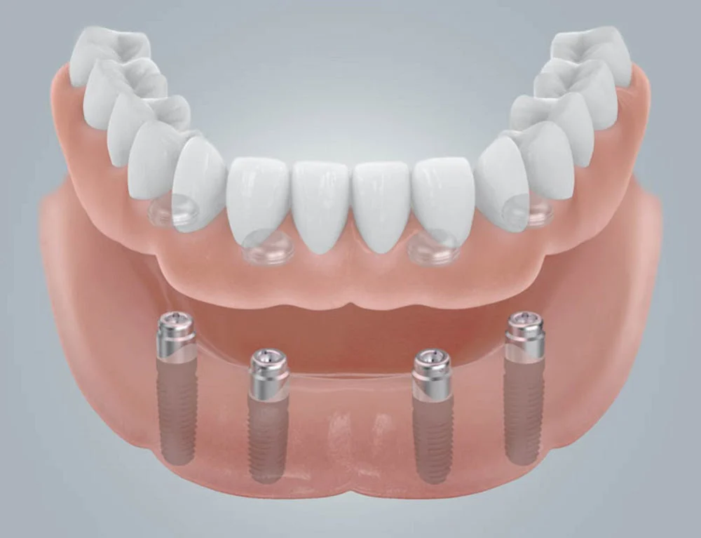 Comfy Denture & Hearing Clinic - Bonney Lake Picture 4