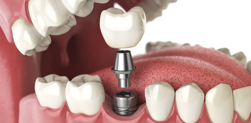 All City Cosmetic Dental Care Picture 8