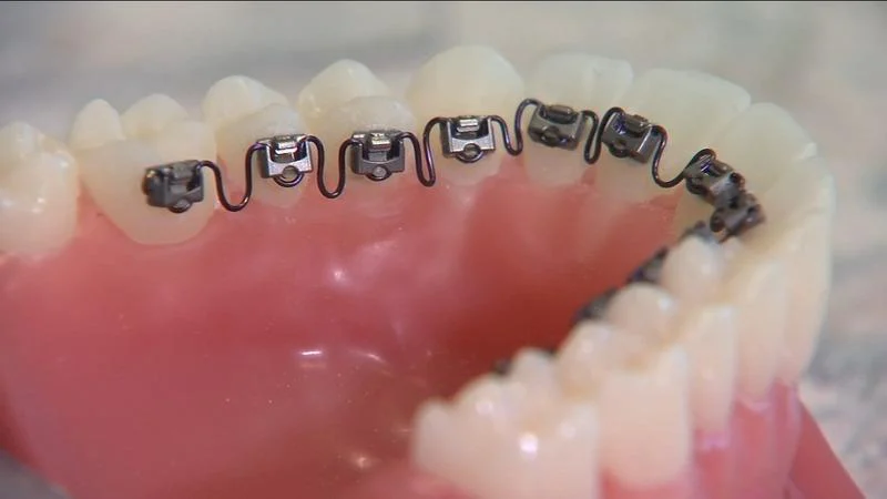 Yang Orthodontics - Invisalign & Braces in Newtown Picture 4