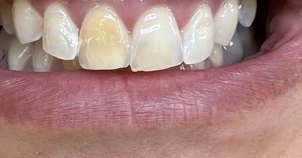 East Coast Dental Design | Mary Ann Garcia DDS | Invisalign Picture 7