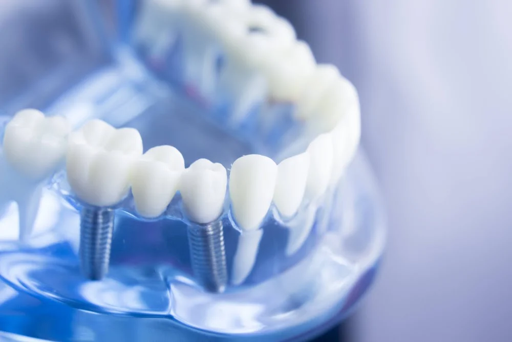Dentist Implants Bucks County Picture 4