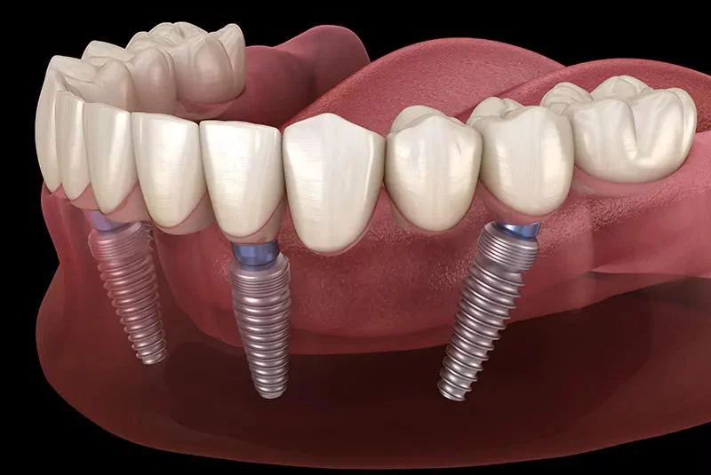 Dental Implants Phoenix Picture 1