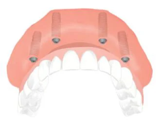 Dental Implant Solutions Kinnelon, NJ Picture 1