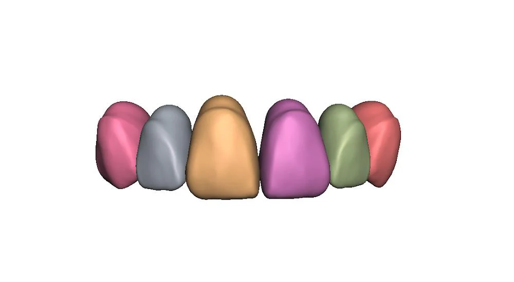 Same Day Dental Crown Picture 1