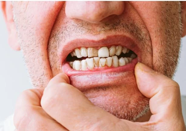 Common Tooth Diseases: Causes, Symptoms, and Treatments