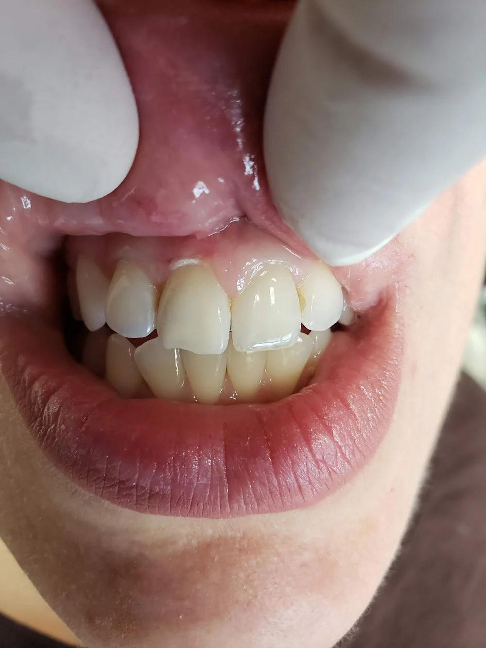 NJ Root Canal Picture 3