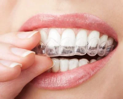 Yang Orthodontics - Invisalign & Braces in Langhorne Picture 2