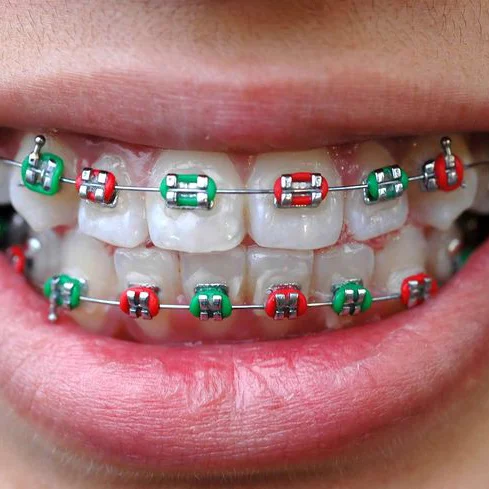 Braces West Chicago IL Picture 4