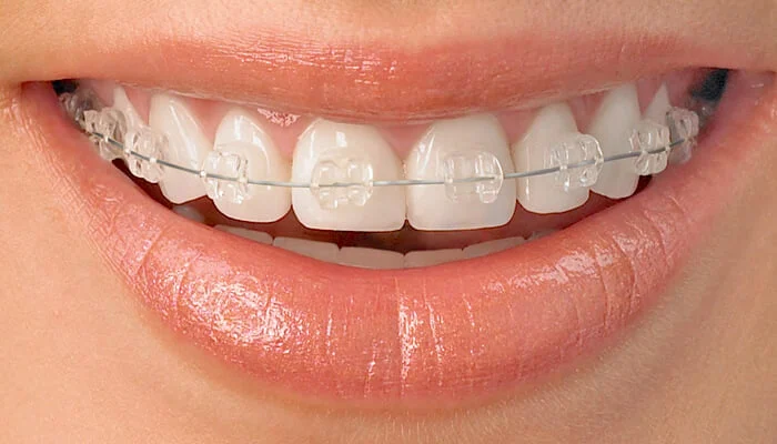 Carpenter Orthodontics- Fred W Carpenter DDS Picture 5