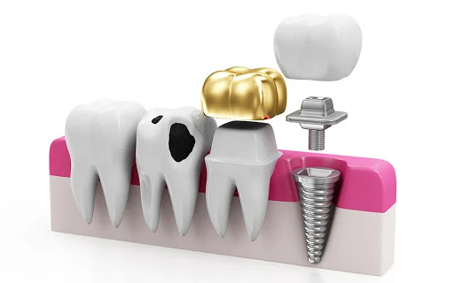 SMILEY DENTAL LOWELL Picture 4
