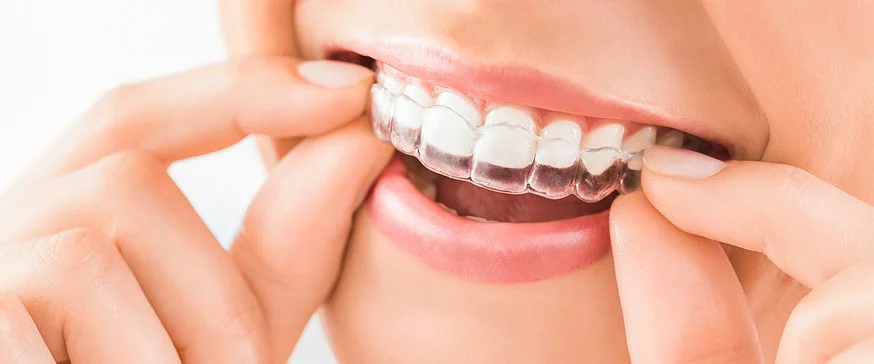bop BRACES-Braces Orthodontics Pediatrics Invisalign Clear Braces Picture 1