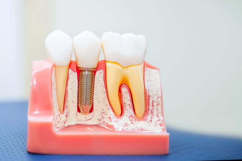 Precision Oral Surgery and Implants Picture 2