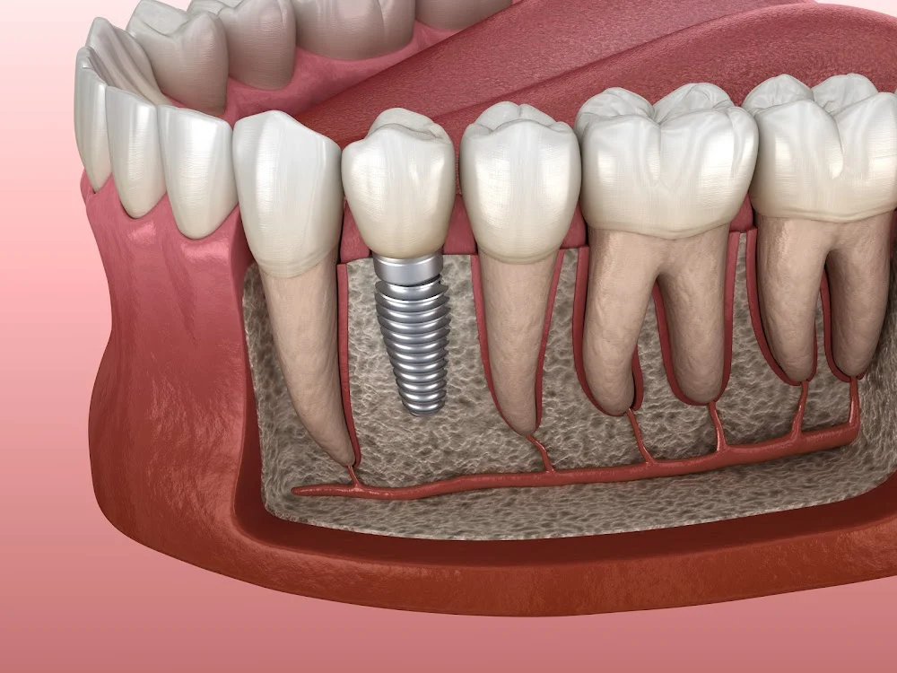 Precision Oral Surgery and Implants Picture 7