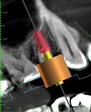 Dental Implant | Crown | Denture Picture 1