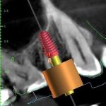 Dental Implant | Crown | Denture