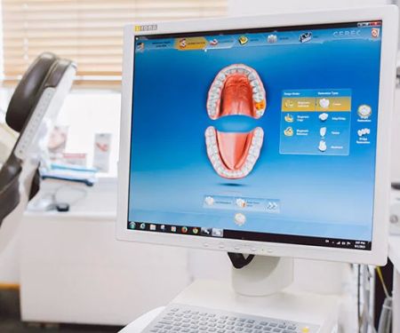Dental Crown in an Hour: Naples
