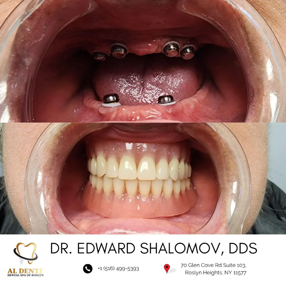 AL Dente Dental Spa of Roslyn - Dr. Edward Shalomov & Dr. Daniel Abramov Picture 7
