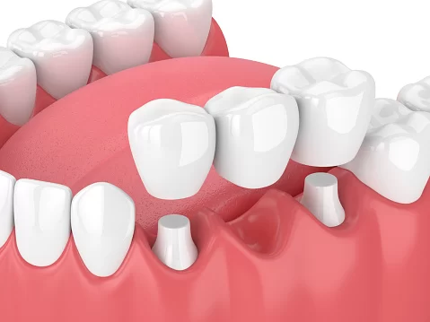 Mercer Island Dental - Invisalign and Sleep Apnea Dentist Picture 2