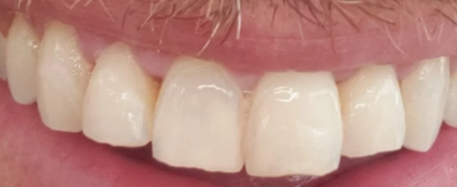 Maui Whitening Orlando Picture 1