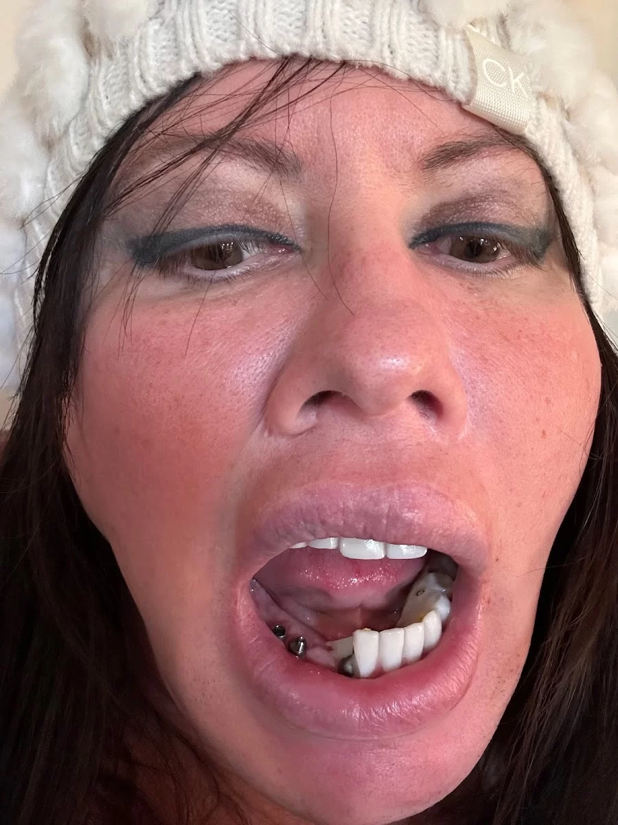 Sedation and Implant Dentistry Las Vegas Picture 9