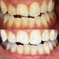 We Whiten ico