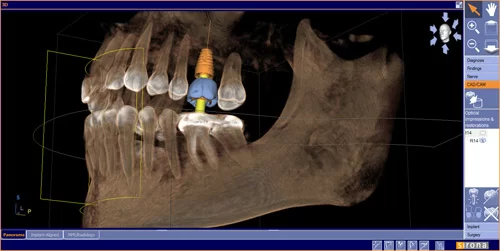 Carolina Implant Picture 1