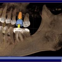 Carolina Implant ico
