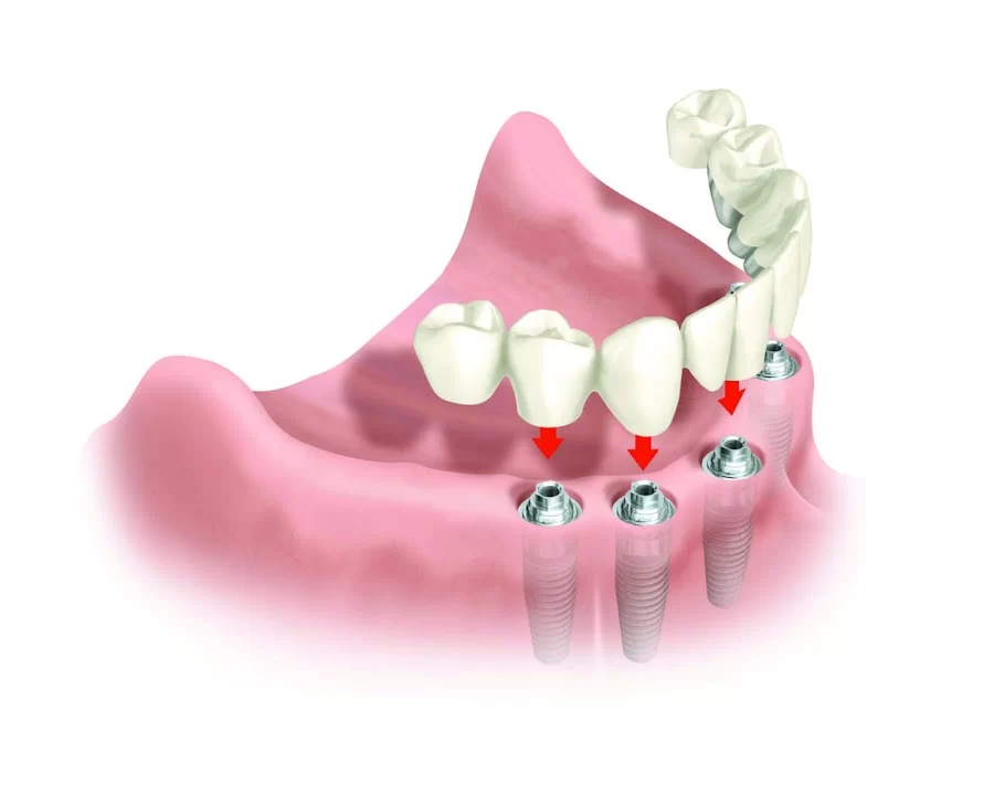Pacific Dental & Implant Solutions Picture 1