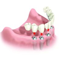Pacific Dental & Implant Solutions ico