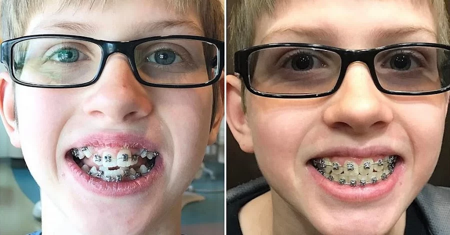 Las Vegas Braces Picture 1