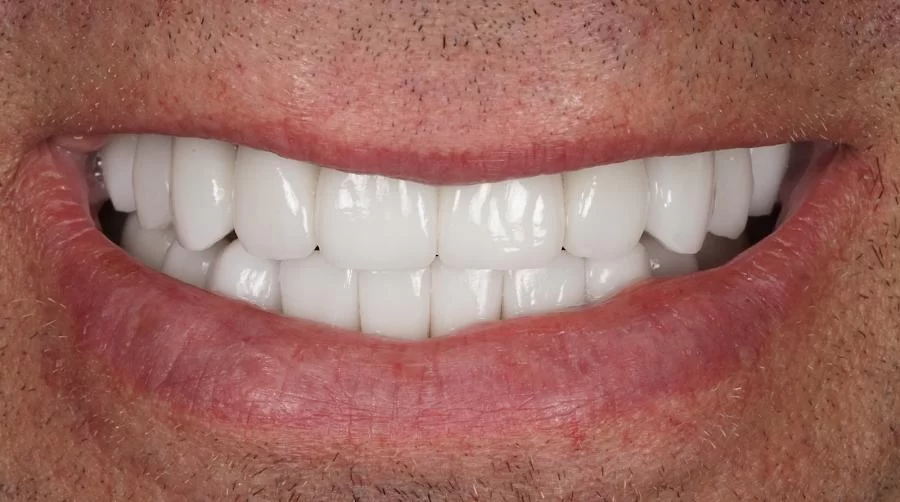 JB White, DDS | Cosmetic Dentist | Dental Implants Picture 8