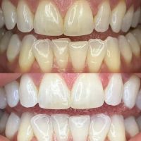 We Whiten ico