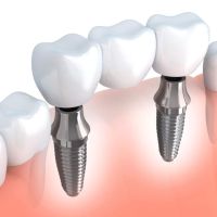 Bismarck Advanced Dental and Implants ico