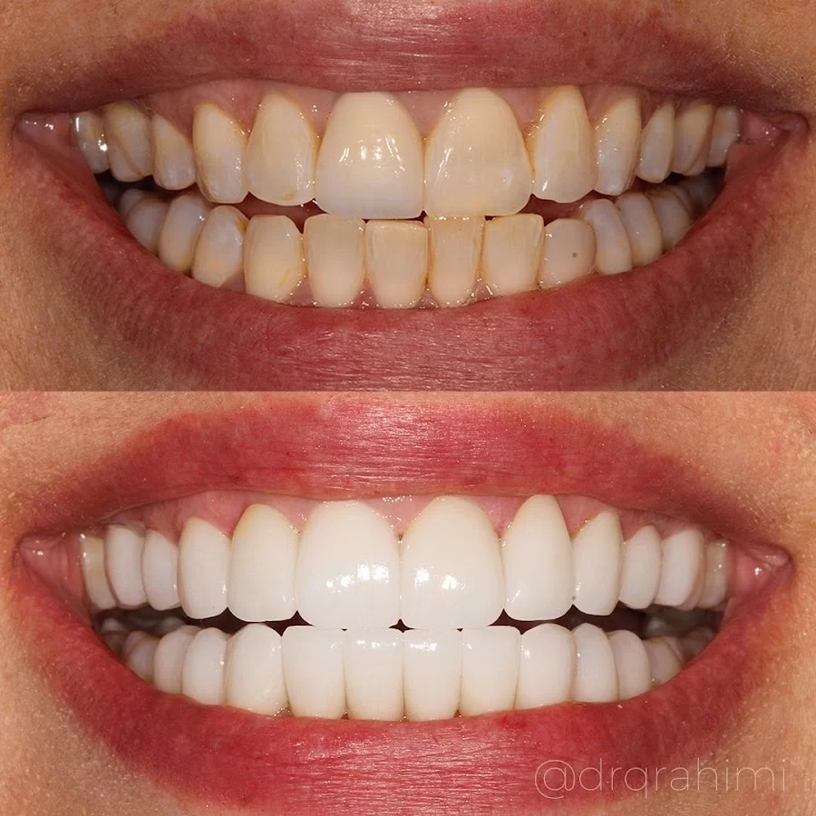 Calabasas Veneers by Dr.Kiumars Rahimi, DDS Dentistry in Calabasas Picture 4
