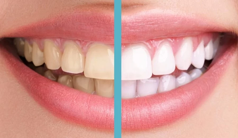 Pasadena Dentist Smile Now Dental Picture 5