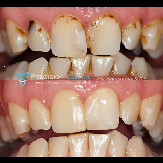 Precision Dental: Leo Aghajanian DDS Picture 6