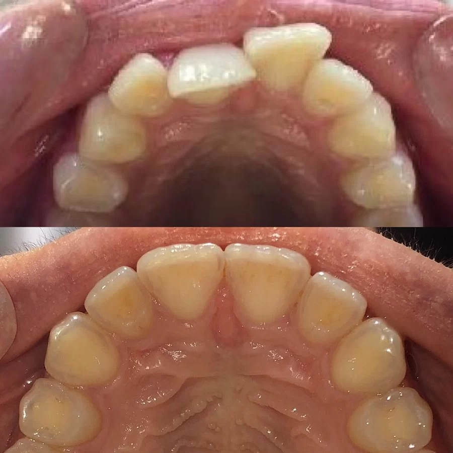 Invisible Braces For You Picture 3