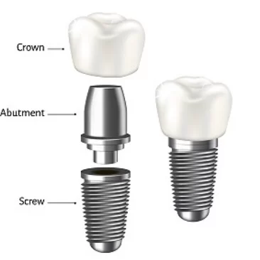 명치과 IMPLANT Dental office Picture 1