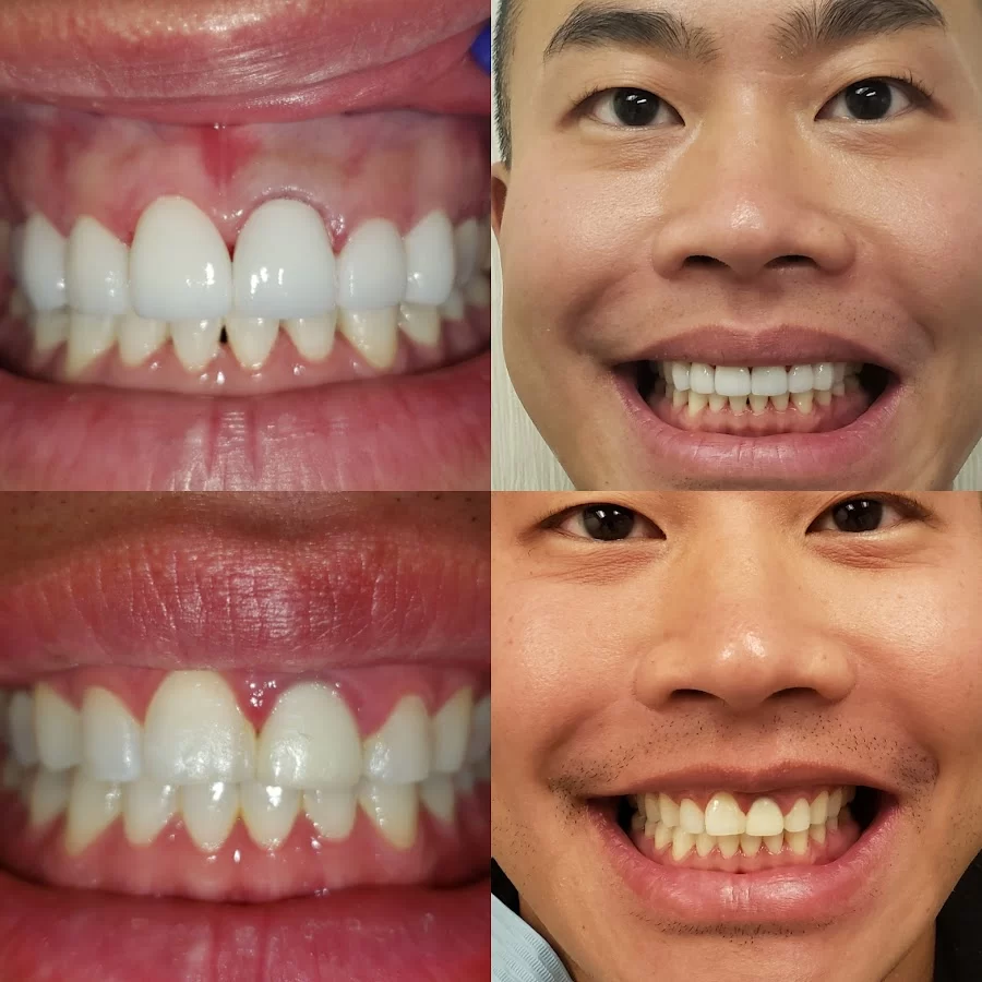 Dentist Culver City - Ocean Breeze Dental - Cosmetic and Emergency Dentist Picture 7