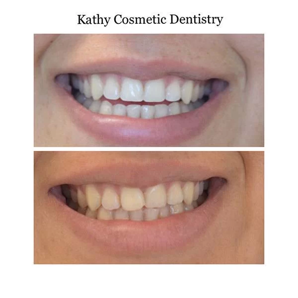Kathy Cosmetic Dentistry Picture 1