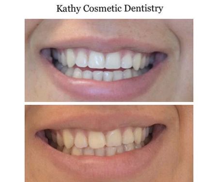 Kathy Cosmetic Dentistry