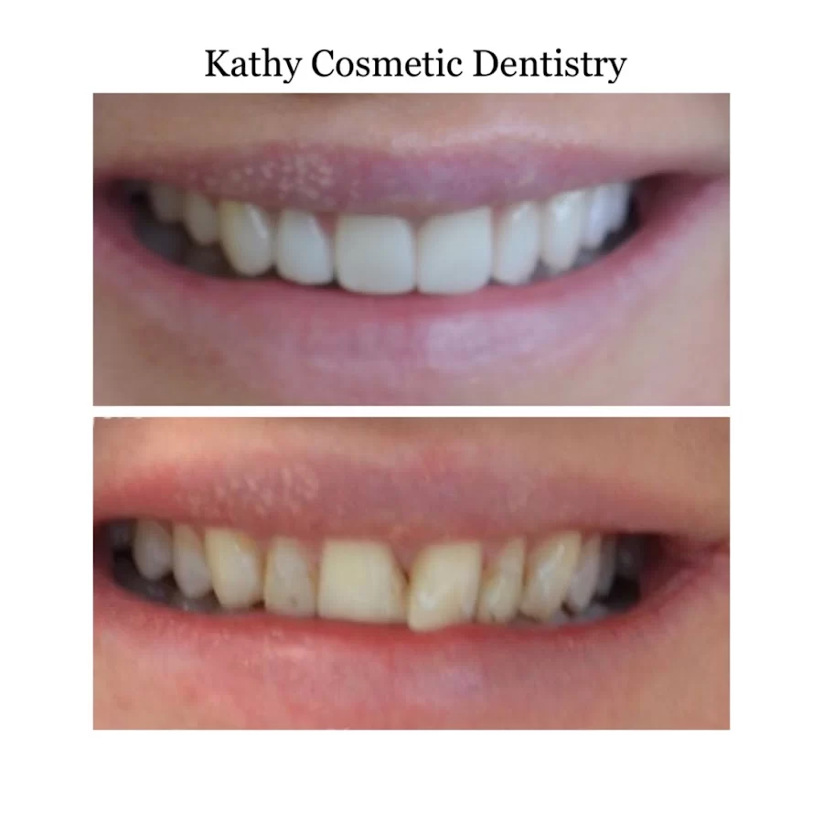 Kathy Cosmetic Dentistry Picture 4
