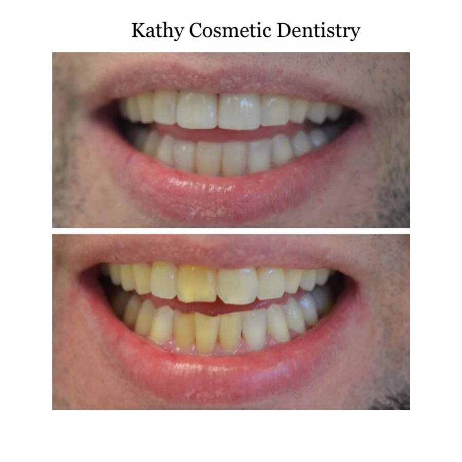 Kathy Cosmetic Dentistry Picture 7