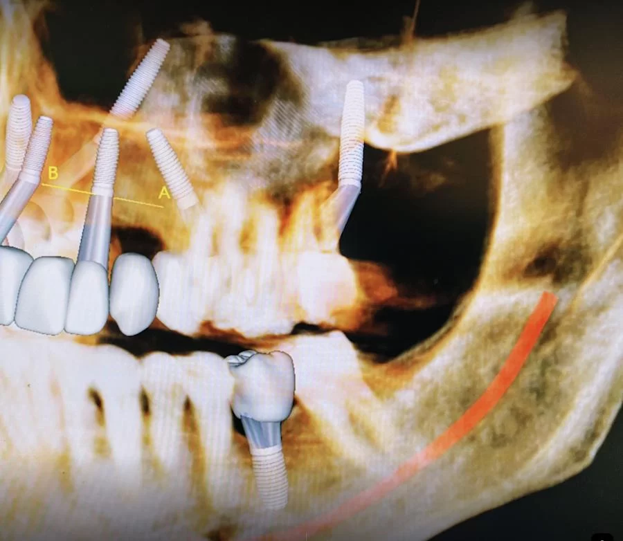 Burbank Dental Implants: Ramsey A. Amin D.D.S. Picture 8